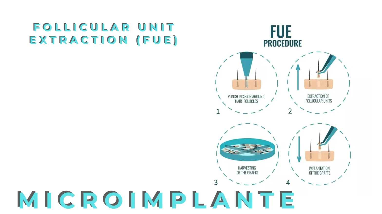 Follicular Unit Extraction (FUE), no más cicatrices!
